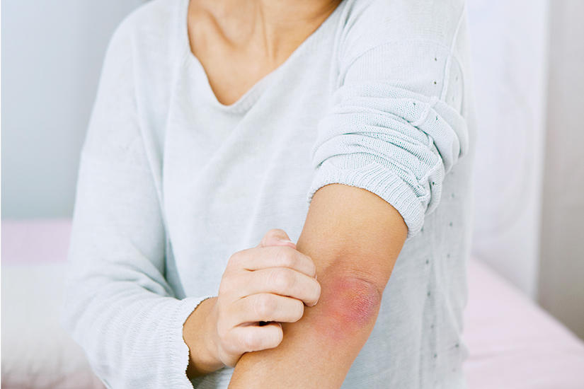 Psorijaza - olakšajte tegobe prirodnim putem